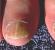Агрессивное воздействие химических средств и факторов среды, приводящих к обезвоживанию пластины ногтя